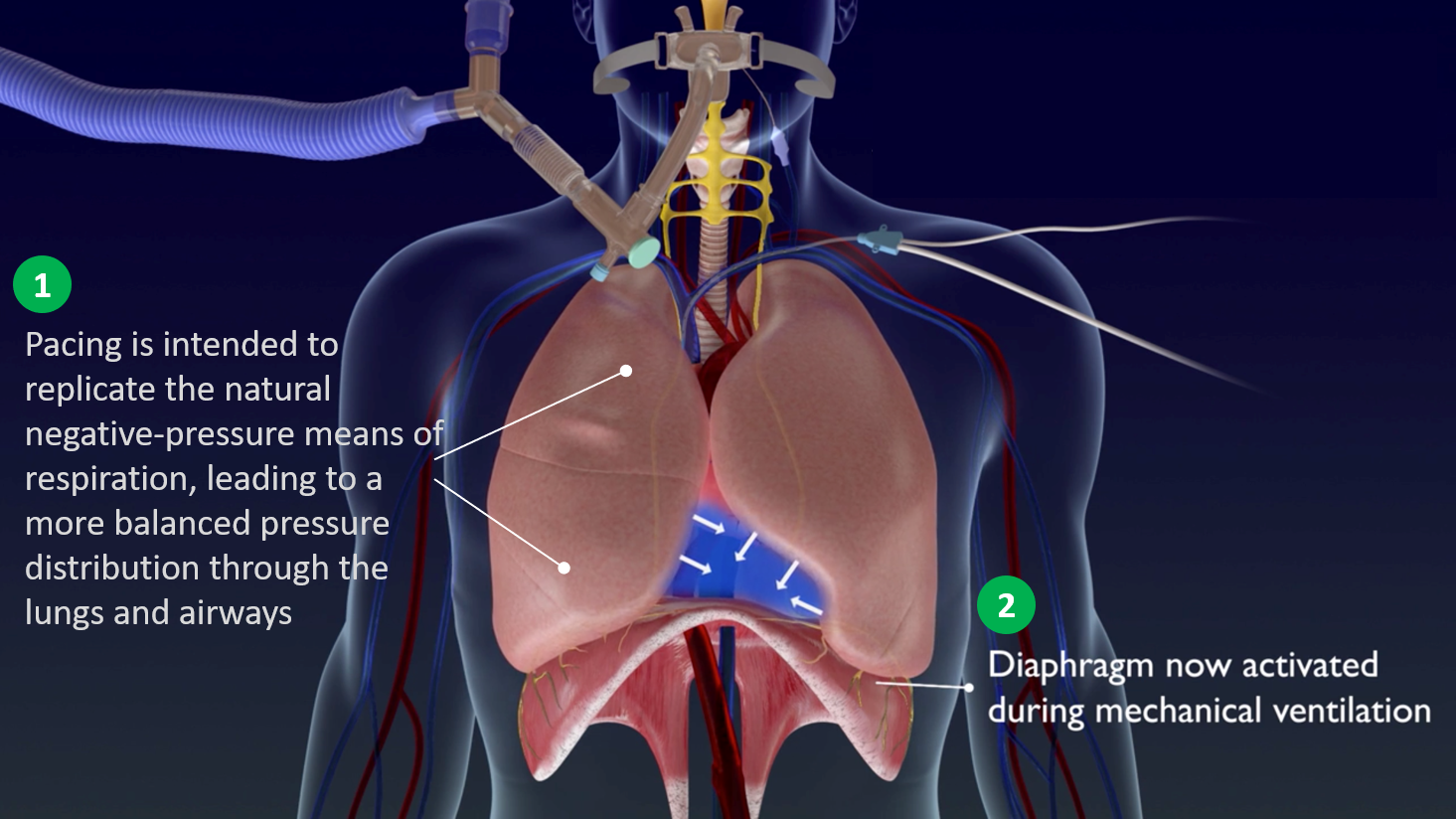With the temporary transvenous diaphragmatic neurostimulator, a central line goes into a vein under the patient’s left collarbone. It contains electrodes that stimulate the phrenic nerves responsible for spurring the diaphragm to contract. This creates negative pressure ventilation, helping to mimic a more natural way of breathing in tandem with the positive pressure caused by the ventilator.